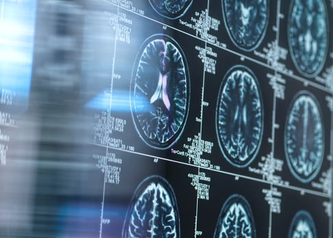 Roche pharmaceutical building, Alzheimer’s disease, brain scan, experimental drug, blood-brain barrier, trontinemab, brain shuttle technology, clinical trial