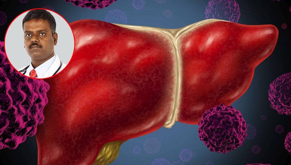 Hepatitis B virus(HBV) may also spread by unprotected sex, says an expert at American Oncology Institute