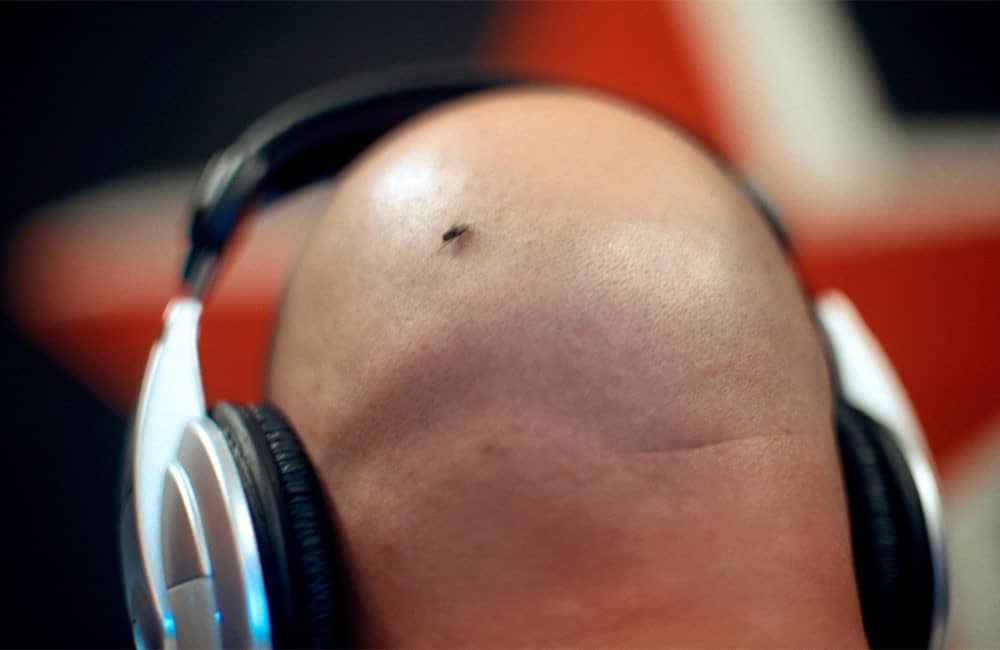 Unraveling the Truth: Christmas tree pattern hair loss explained