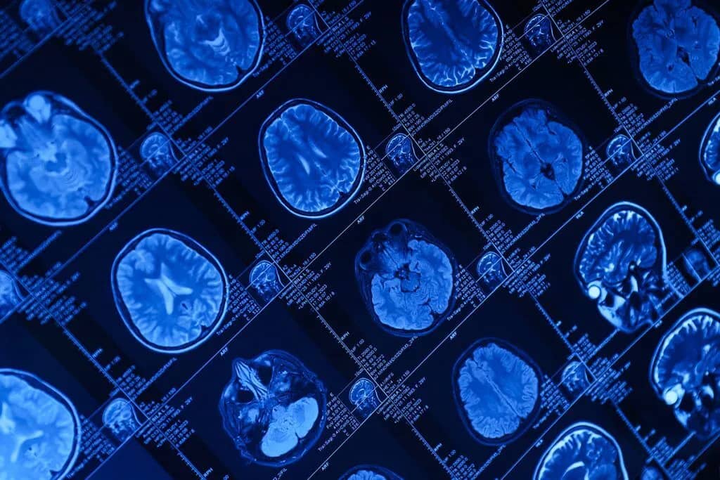 Huntington’s disease gene therapy AMT-130 delivered by MRI-guided neurosurgery at UCLH