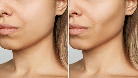 Buccal Fat Removal