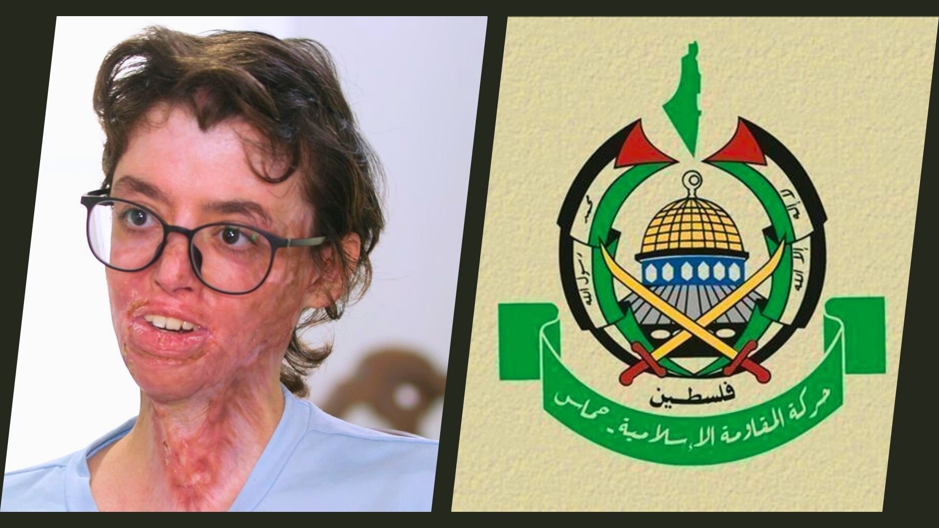 palestinian-girl-sarah-Burned-in-Israeli-Attack-on-Gaza-Palestine