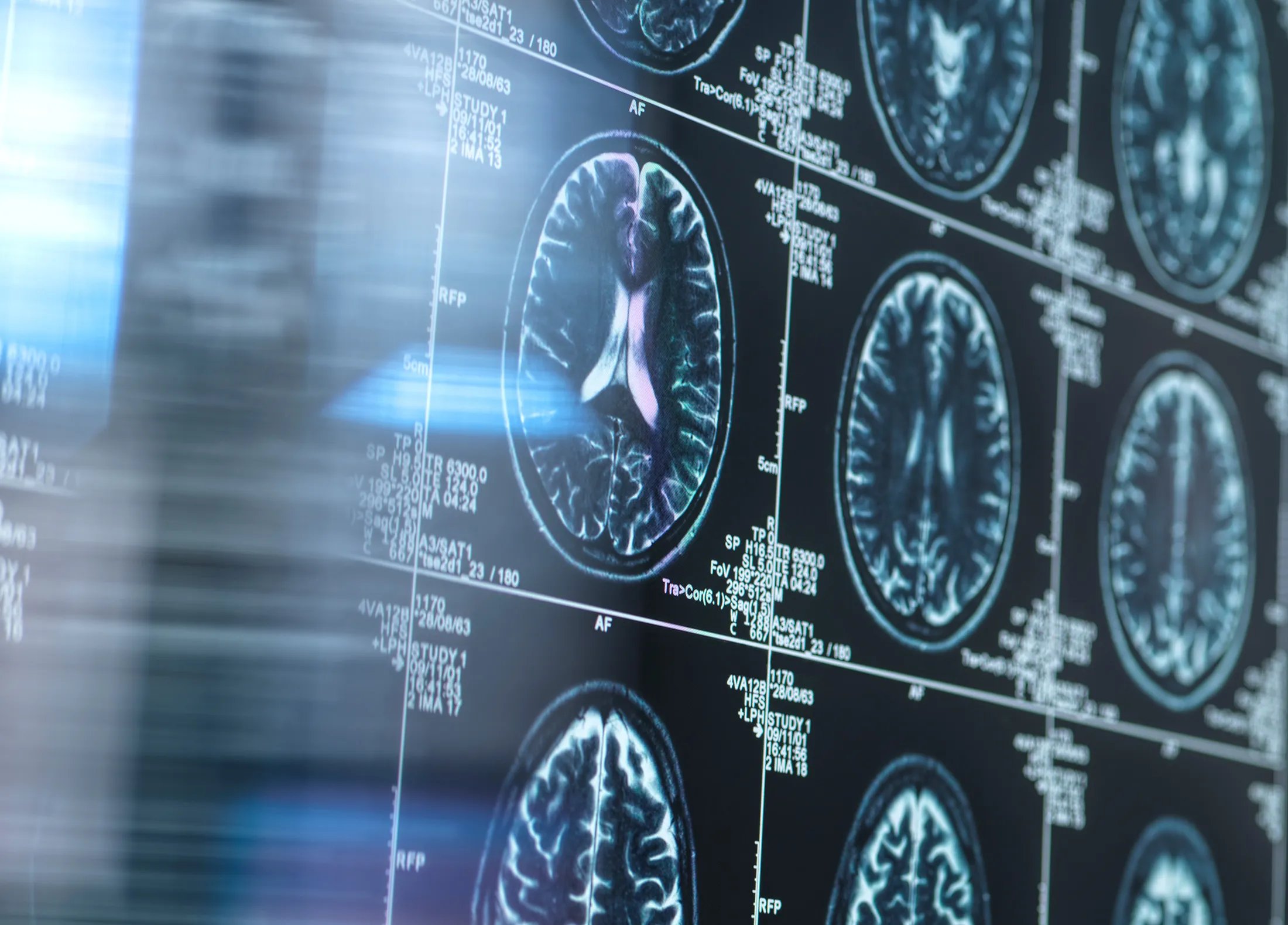 Roche pharmaceutical building, Alzheimer’s disease, brain scan, experimental drug, blood-brain barrier, trontinemab, brain shuttle technology, clinical trial