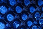 Huntington’s disease gene therapy AMT-130 delivered by MRI-guided neurosurgery at UCLH