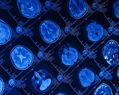Huntington’s disease gene therapy AMT-130 delivered by MRI-guided neurosurgery at UCLH