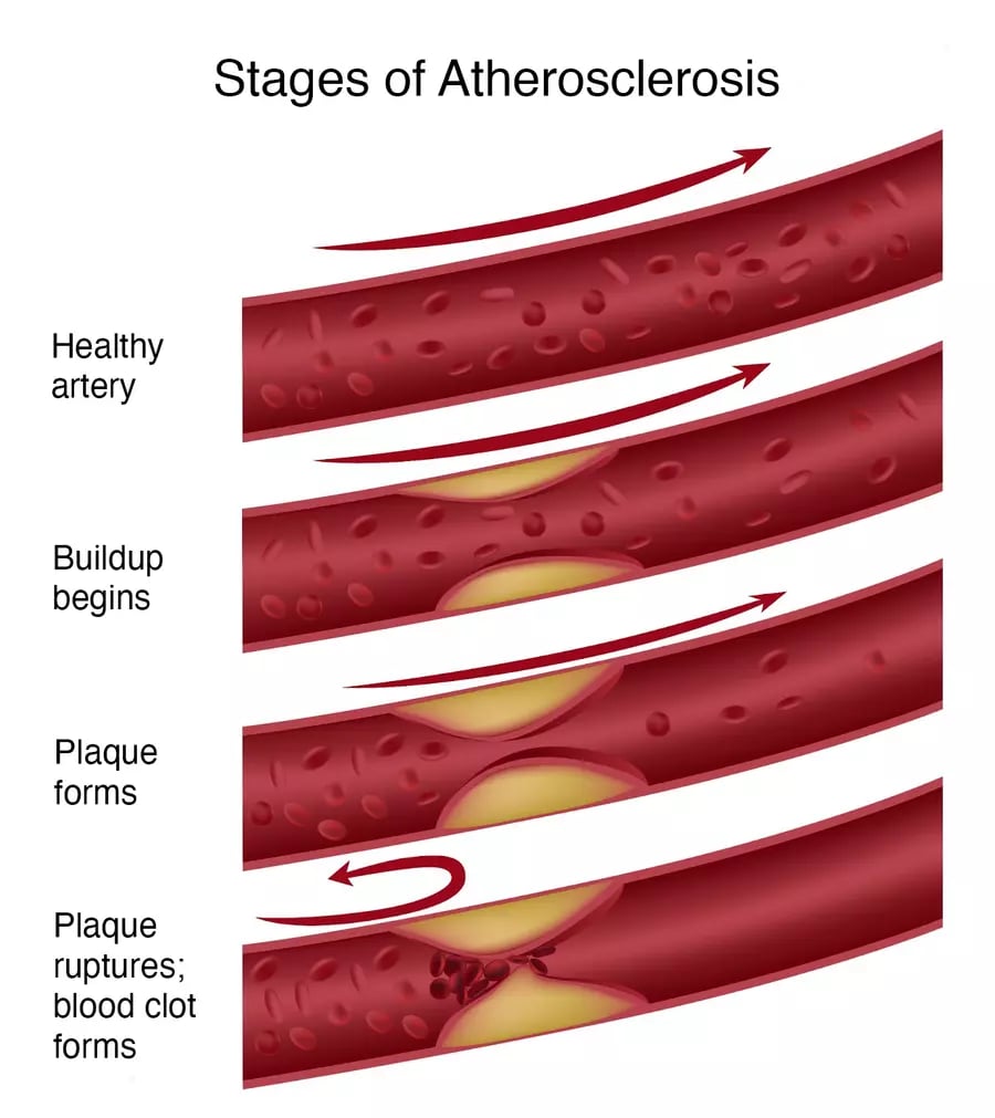 Illustration of LDL cholesterol plaque buildup in arteries leading to heart disease