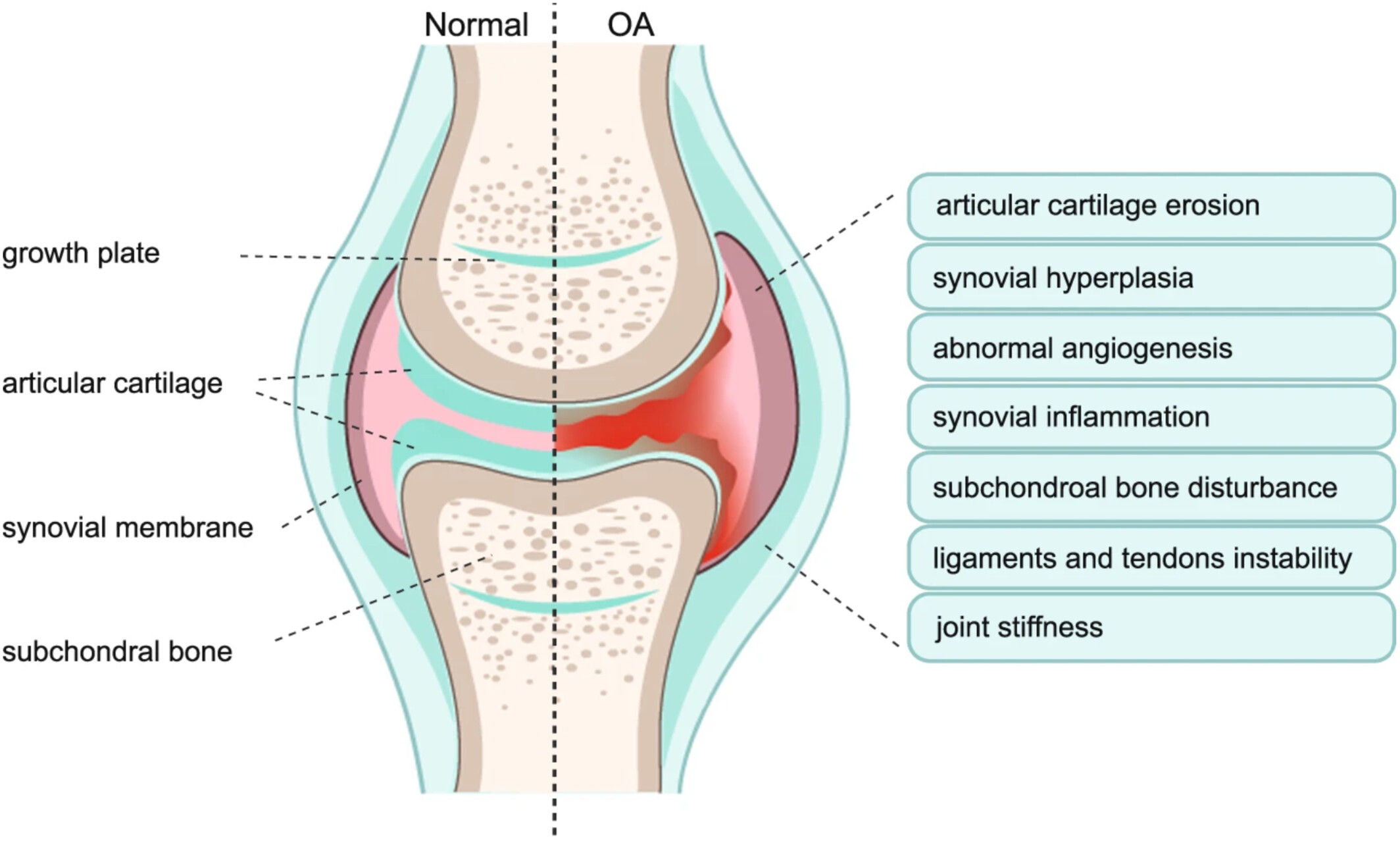 Before and after cartilage regeneration in osteoarthritis treatment