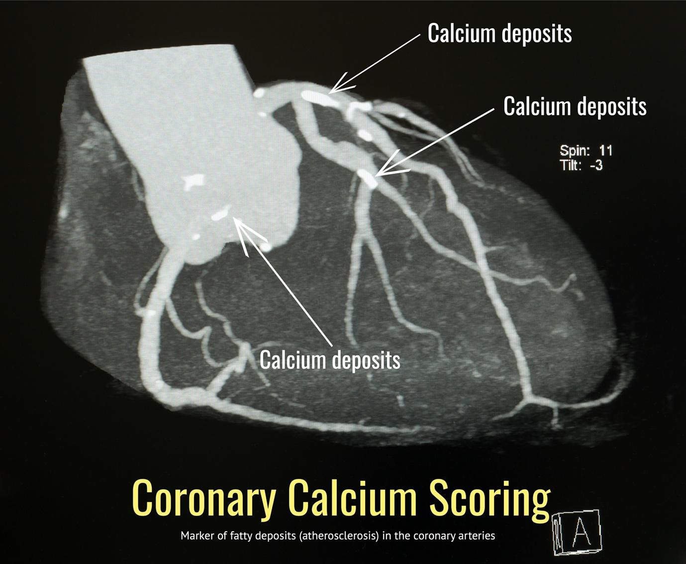 Coronary artery calcium scan used to detect early heart disease risk