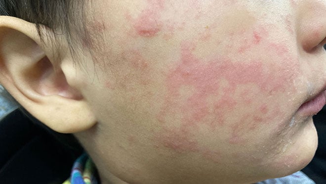 Child showing measles rash symptoms