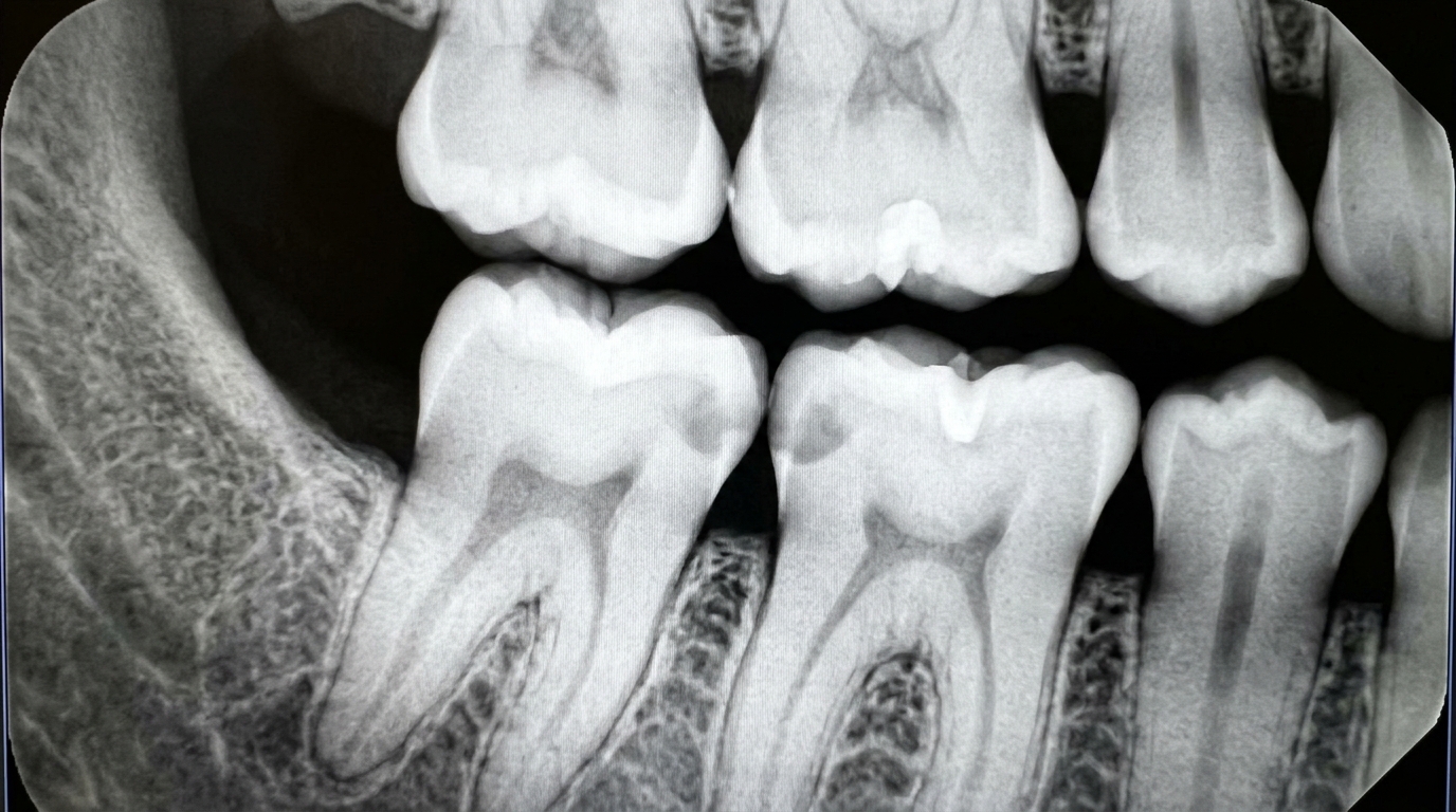 Dental X-ray showing early enamel demineralization indicating initial cavity formation