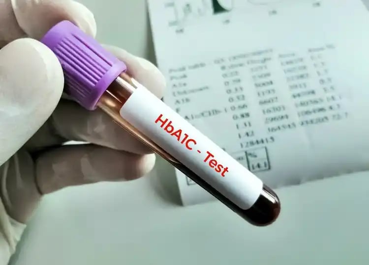 HbA1c blood sample used to measure average blood sugar levels