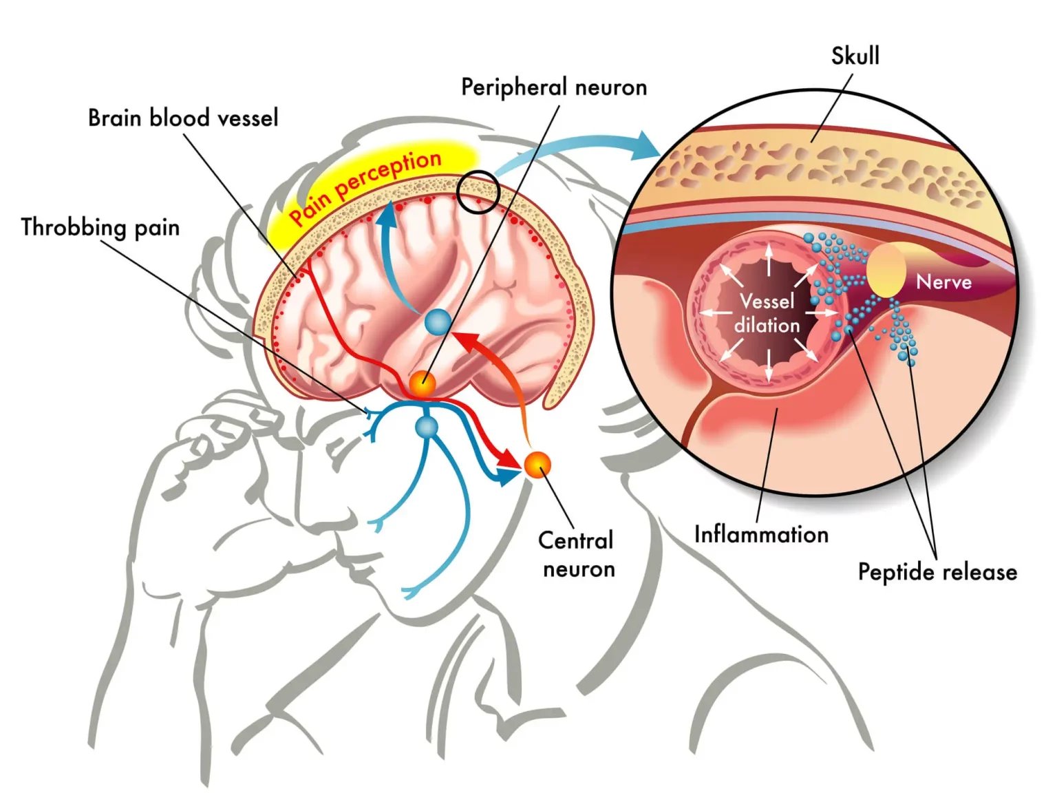 Medical illustration of brain nerve pathways involved in migraine headache
