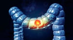 Medical illustration of colon cancer rising in young adults under 50