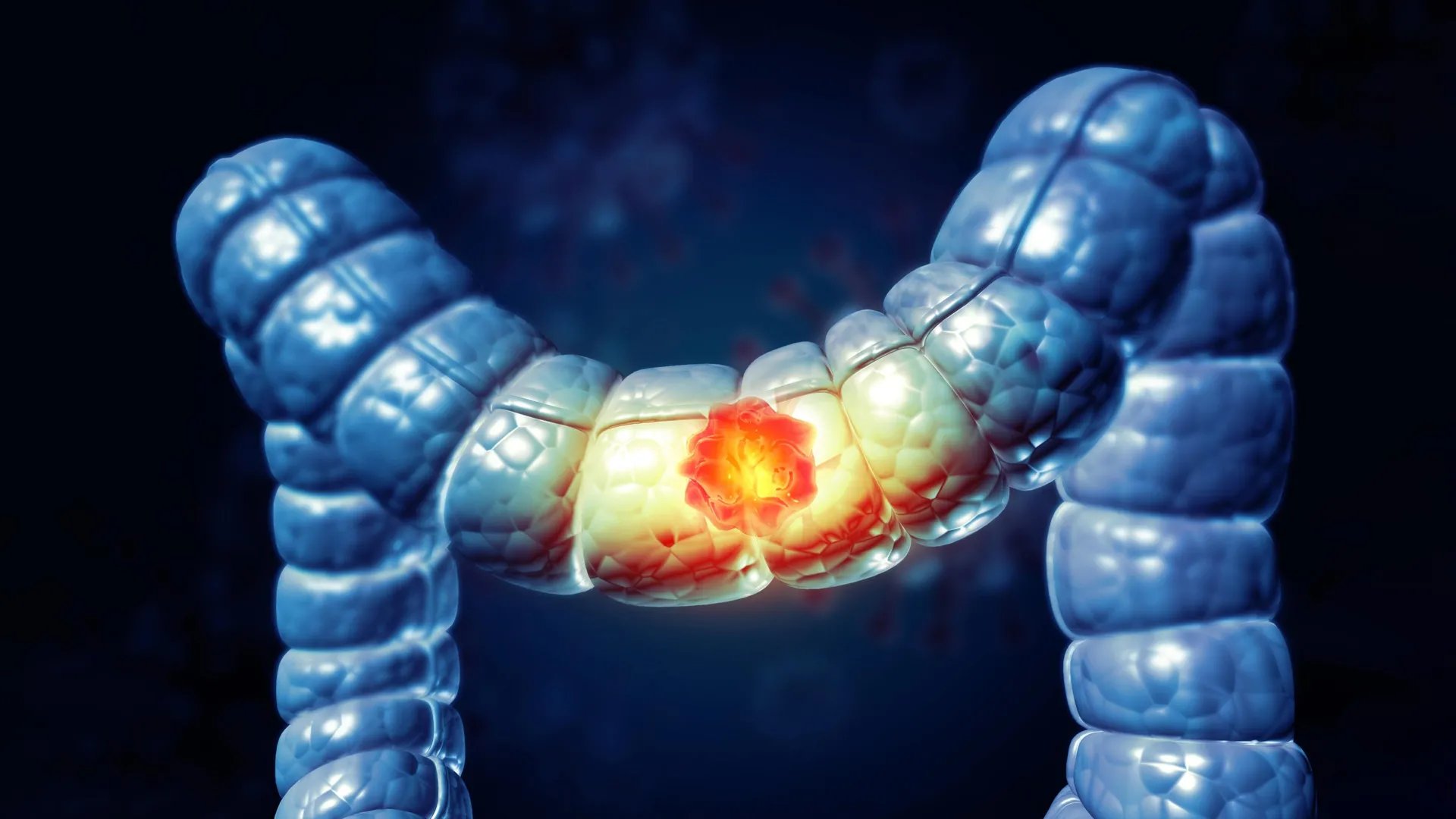 Medical illustration of colon cancer rising in young adults under 50