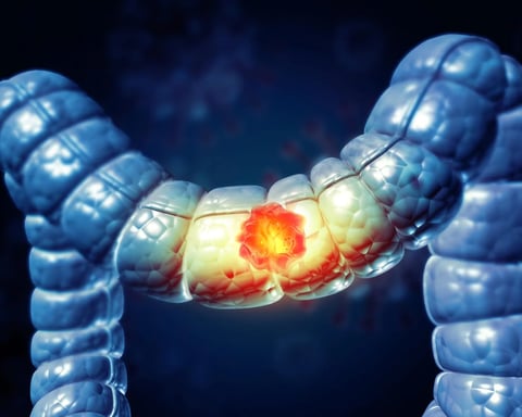 Medical illustration of colon cancer rising in young adults under 50