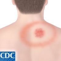 Erythema migrans bullseye rash on arm, the hallmark early symptom of Lyme disease infection