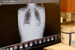 A lung X-ray on a screen, illustrating GSK's $10.6 billion deal for lung cancer drugmaker Nuvalent