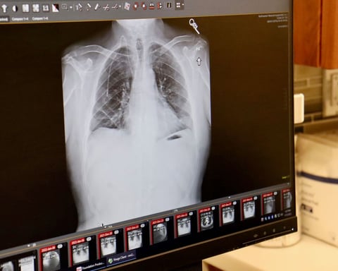 A lung X-ray on a screen, illustrating GSK's $10.6 billion deal for lung cancer drugmaker Nuvalent