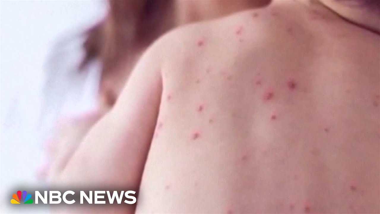 News coverage of rising measles cases in the United States in 2026 as the case count surpassed 2,000 infections