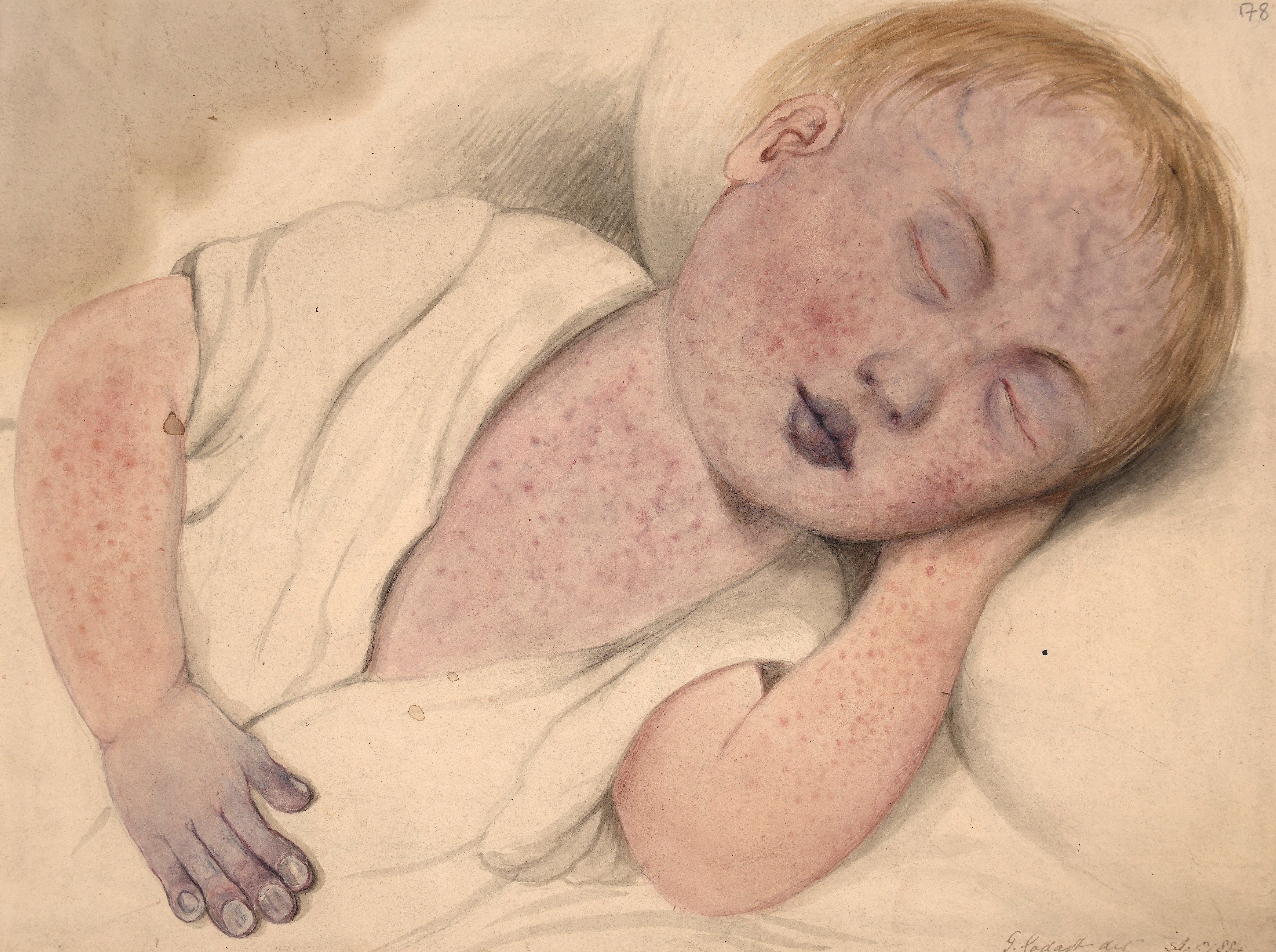Historical photograph of a child with severe measles, the disease responsible for 2,104 US cases in 2026