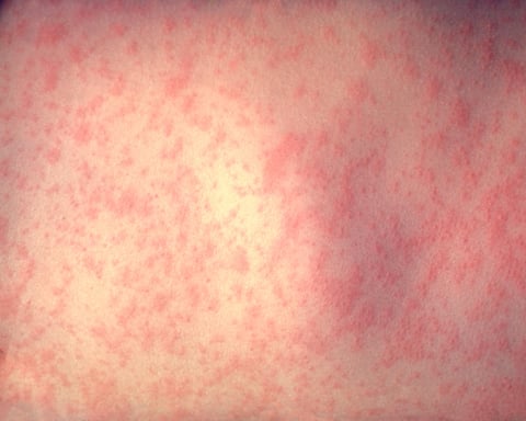 Morbillivirus measles infection microscopy image — 2026 US measles outbreak has confirmed 2,104 cases