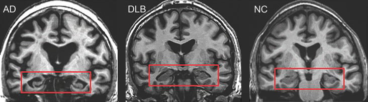 MRI brain scan comparing Alzheimer disease and dementia with Lewy bodies, illustrating the neurological changes linked to varicella-zoster virus inflammation