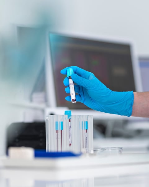 Medical professional holding a blood sample vial in a clinical setting, central to a Northwestern University JAMA study on apoB vs LDL cholesterol testing for statin therapy decisions