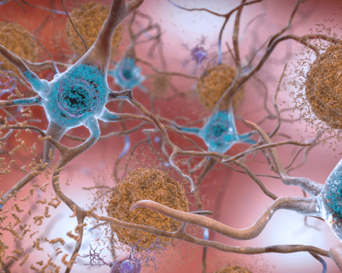 Illustration showing brown amyloid plaques between neurons and blue tau tangles inside neurons in Alzheimer's disease