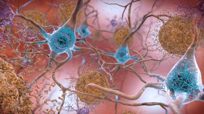 Illustration showing brown amyloid plaques between neurons and blue tau tangles inside neurons in Alzheimer's disease