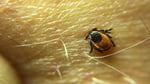 Close-up of a blacklegged tick embedded in human skin during peak tick season