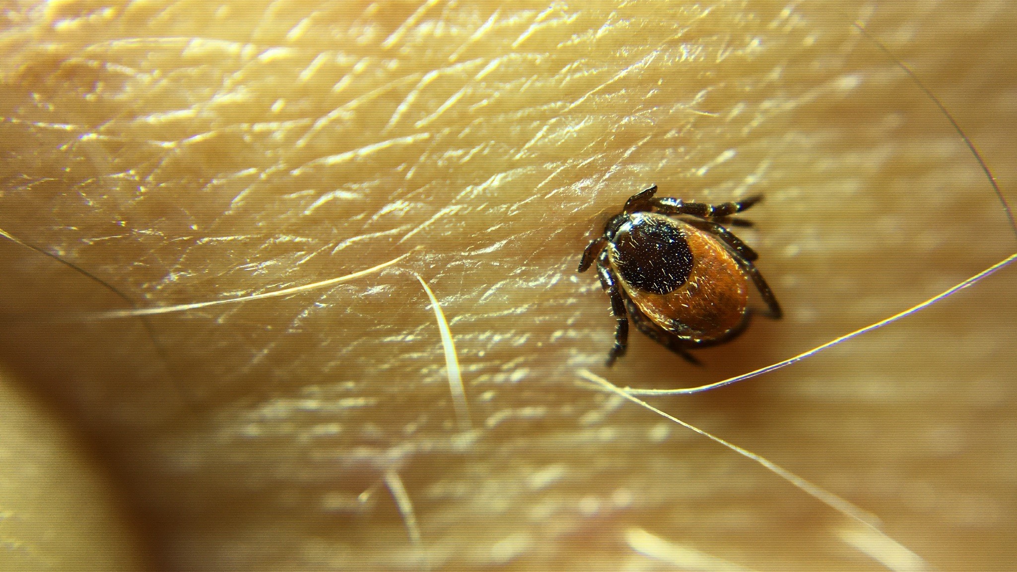 Close-up of a blacklegged tick embedded in human skin during peak tick season