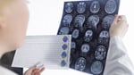 A physician reviews brain scan images in a clinical setting for epilepsy diagnosis