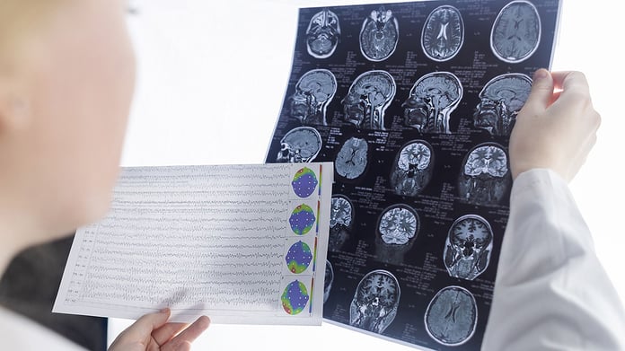 A physician reviews brain scan images in a clinical setting for epilepsy diagnosis