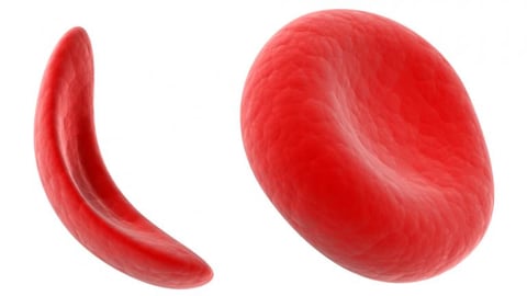 CRISPR gene editing used in Casgevy treatment for sickle cell disease patients