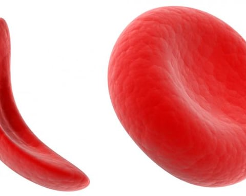 CRISPR gene editing used in Casgevy treatment for sickle cell disease patients