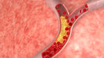 Illustration of cholesterol plaque buildup in blood vessels representing cardiovascular disease risk