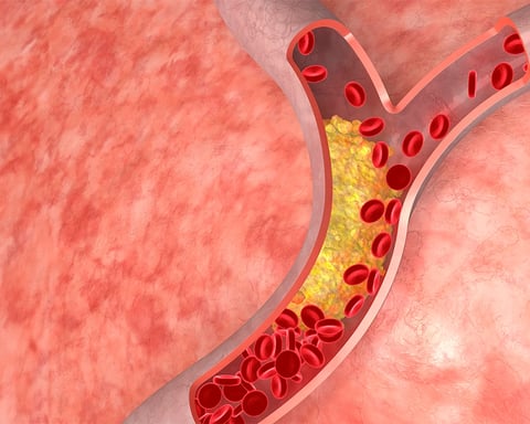 Illustration of cholesterol plaque buildup in blood vessels representing cardiovascular disease risk
