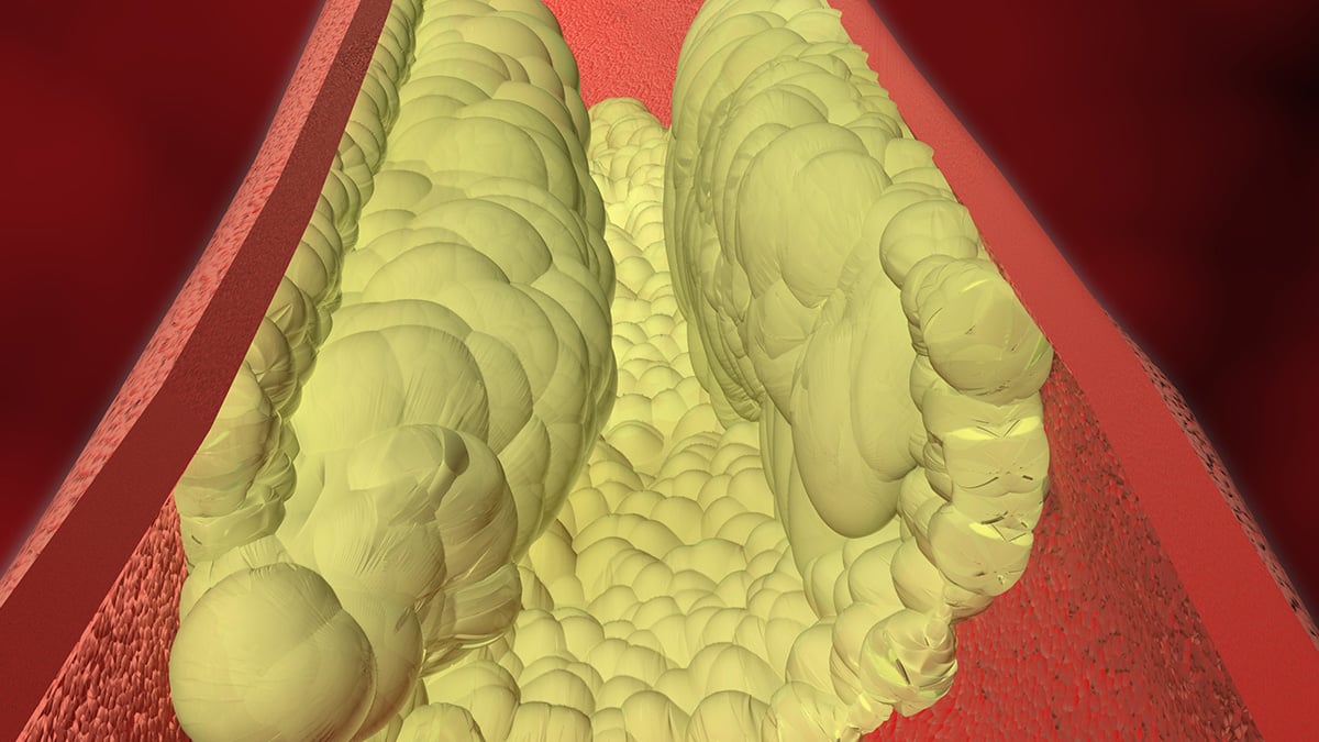 Illustration showing high cholesterol risk factors and cardiovascular disease statistics from the CDC