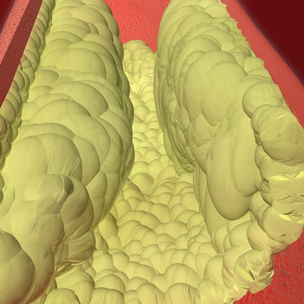 Illustration showing high cholesterol risk factors and cardiovascular disease statistics from the CDC
