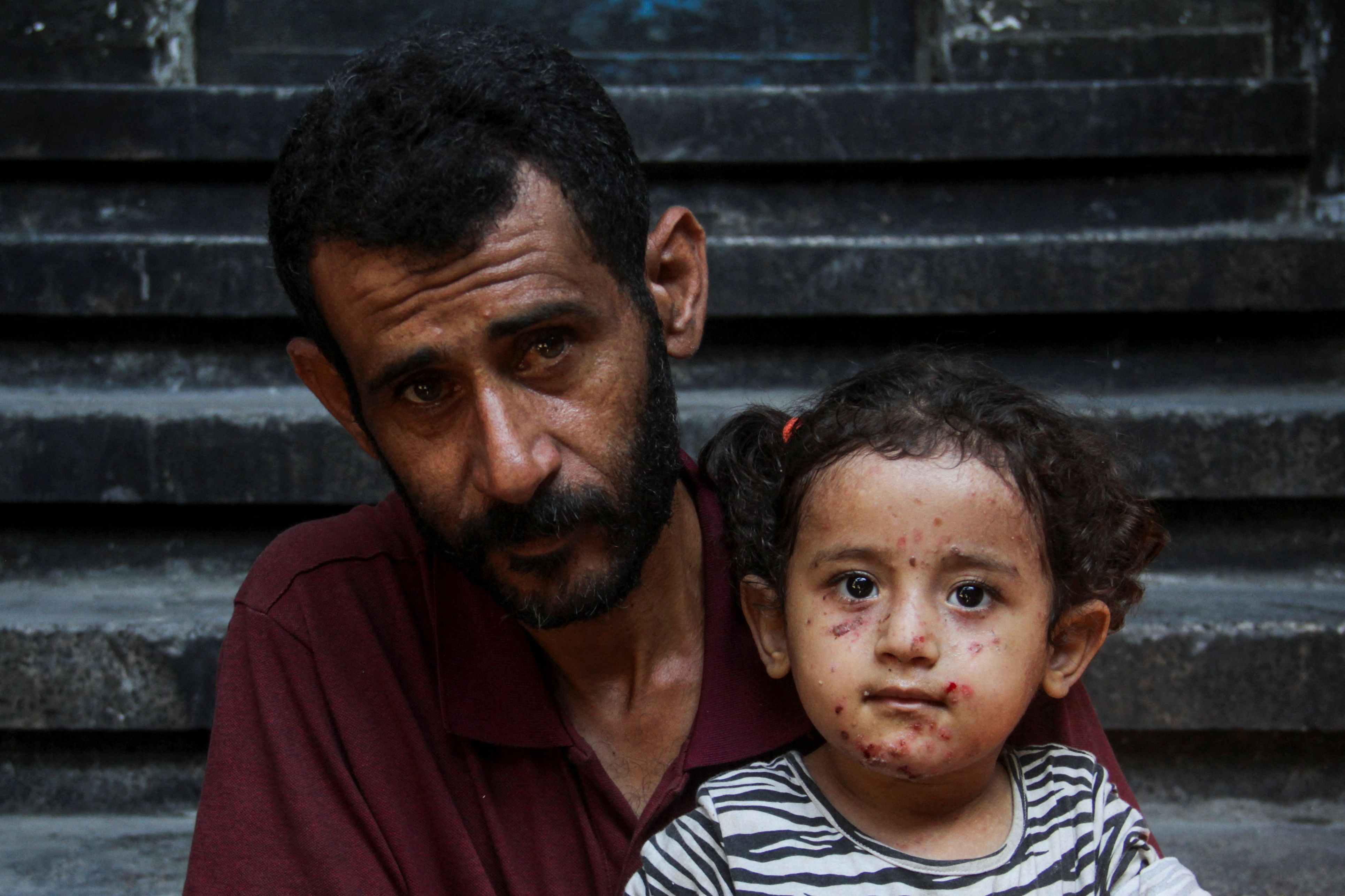 Palestinian child with chickenpox skin disease in Gaza displacement camp