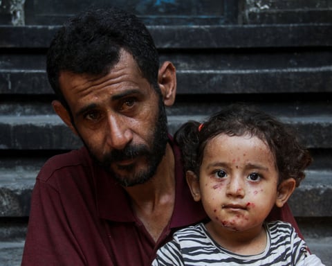 Palestinian child with chickenpox skin disease in Gaza displacement camp
