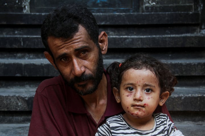 Palestinian child with chickenpox skin disease in Gaza displacement camp