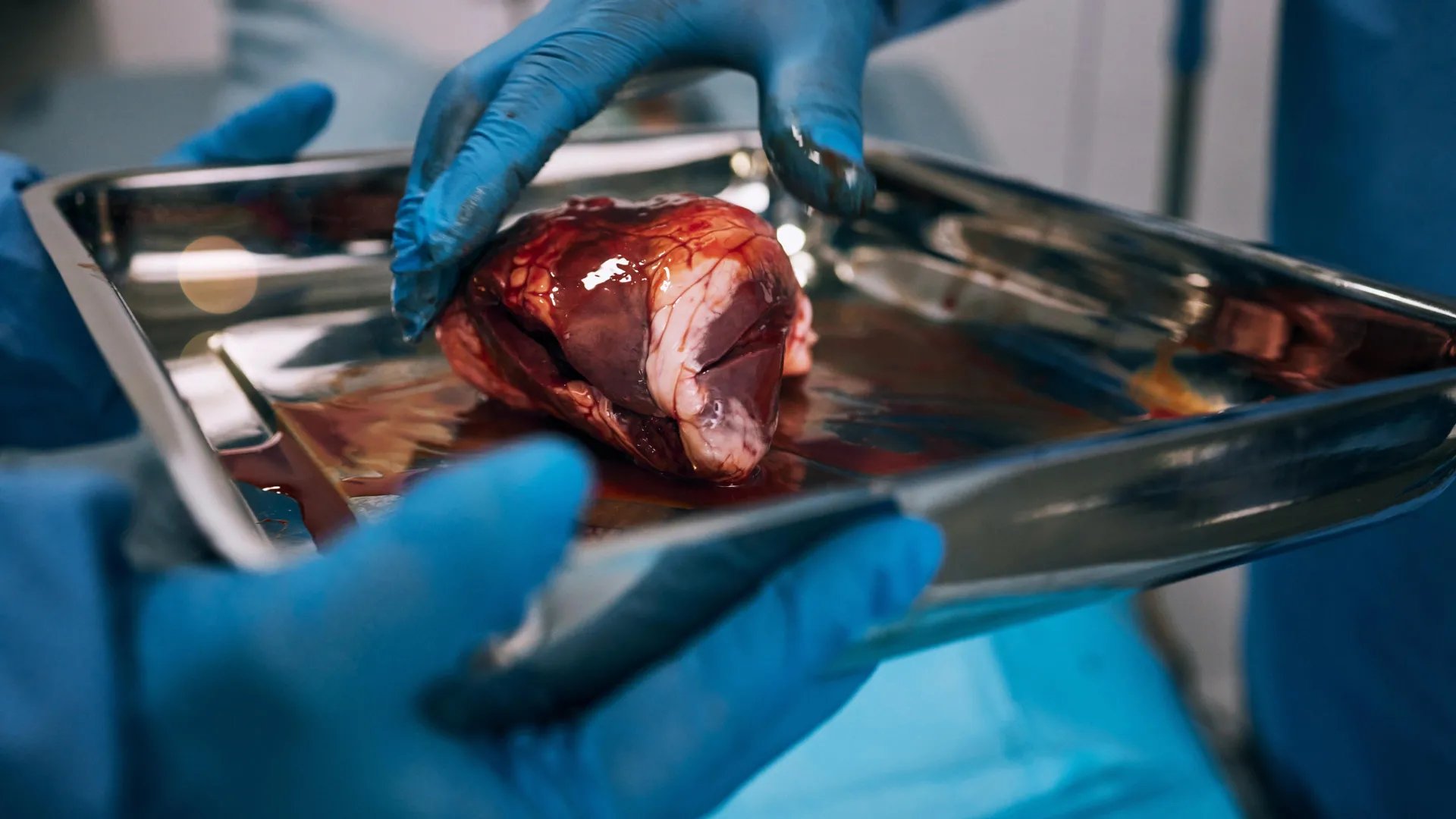 Surgeons in an operating room performing a kidney transplant procedure
