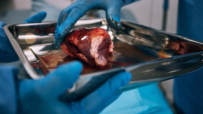Surgeons in an operating room performing a kidney transplant procedure