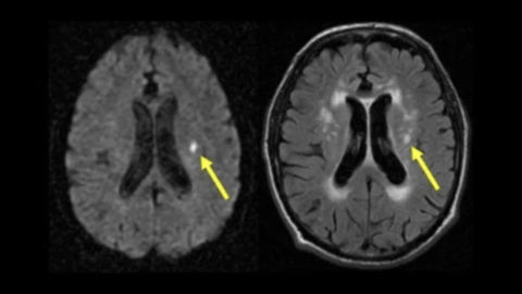 MRI brain scan showing lacunar stroke small vessel disease studied by University of Edinburgh researchers