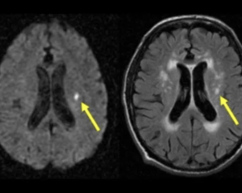 MRI brain scan showing lacunar stroke small vessel disease studied by University of Edinburgh researchers