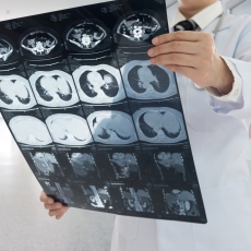 Medical illustration depicting liver cancer, the disease at the centre of Cedars-Sinai's 354,957-person coffee and liver health study
