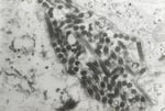 Transmission electron microscopic image confirming Marburg virus in a hemorrhagic fever patient