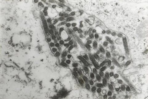 Transmission electron microscopic image confirming Marburg virus in a hemorrhagic fever patient