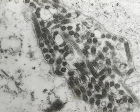 Transmission electron microscopic image confirming Marburg virus in a hemorrhagic fever patient